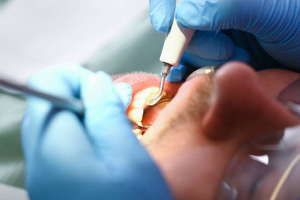 Best Emergency Root Canal Treatment in Elkridge, MD