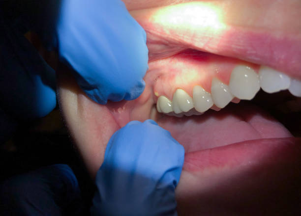 Best Emergency Dental Care for Abscessed Tooth in Elkridge, MD