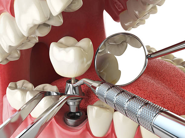 Best Emergency Dentist for Lost Fillings or Crowns in Elkridge, MD